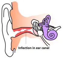 swimmers ear